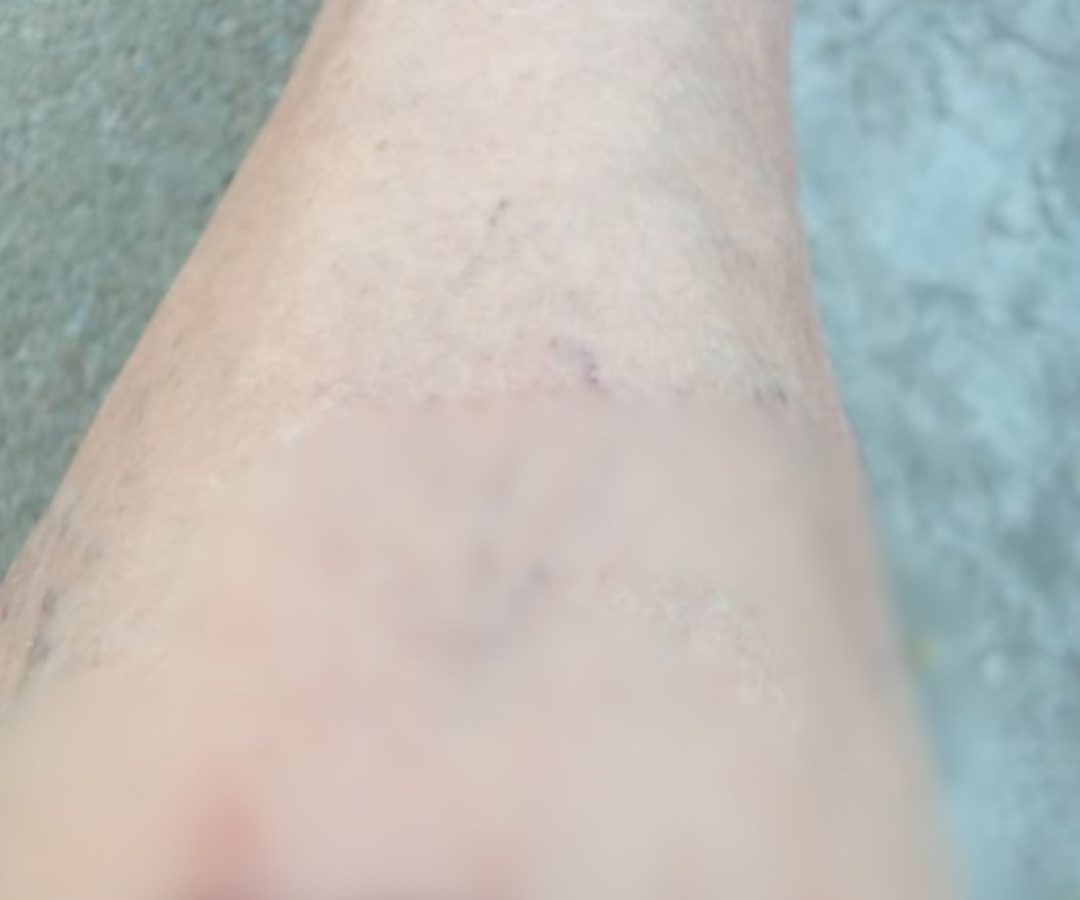 Ataques de cães não param em Serra Talhada; agente de saúde foi alvo